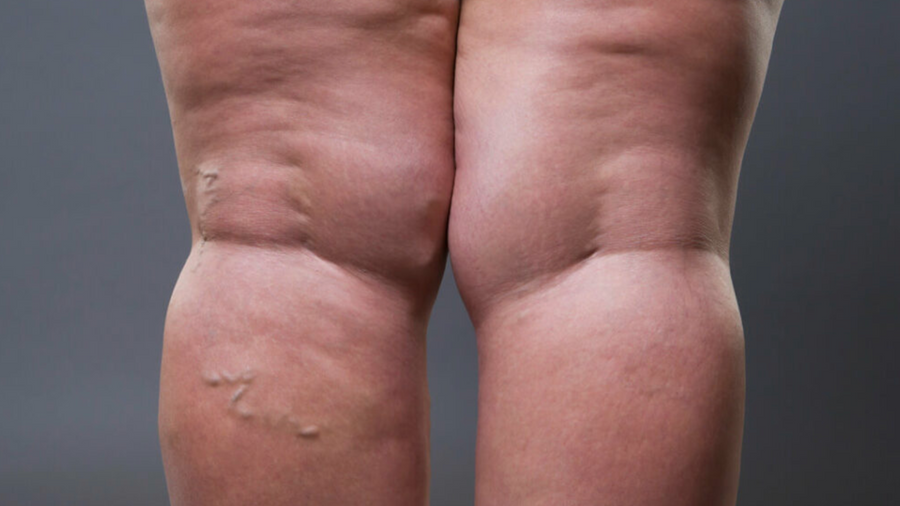 ¿Qué es el lipedema?